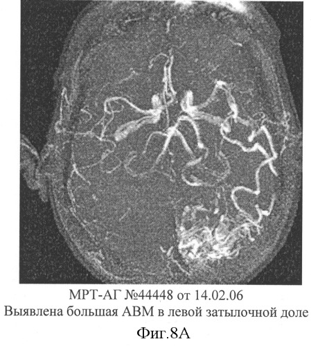 Способ эмболизации артериовенозных мальформаций головного мозга в условиях общей анестезии и управляемой гипотонии (патент 2315634)