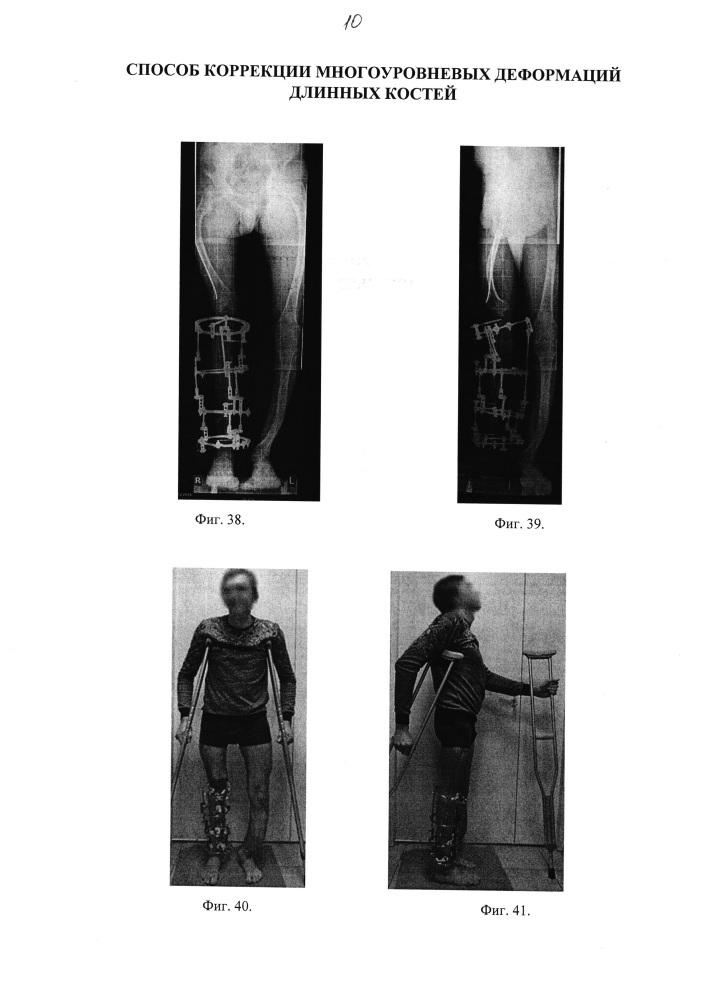Способ коррекции многоуровневых деформаций длинных костей (патент 2640999)