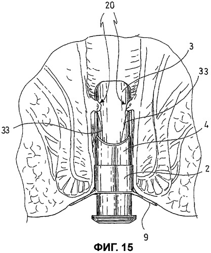 Хирургическое устройство для чрезанального доступа к прямой кишке пациента (патент 2445020)