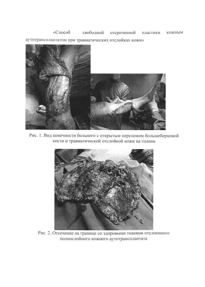 Способ свободной отсроченной пластики кожным аутотрансплантатом при травматических отслойках кожи (патент 2665676)