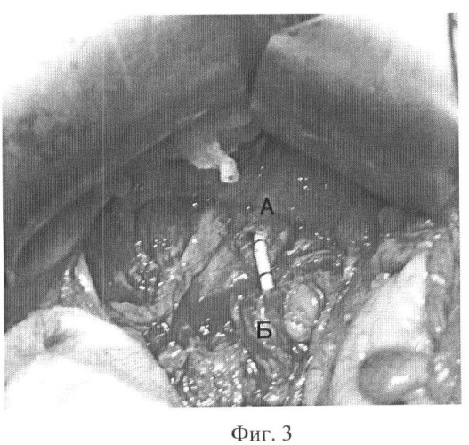 Способ хирургического лечения сужения тазового отдела мочеточника у больных с удаленной или нефункционирующей противоположной почкой (патент 2373868)