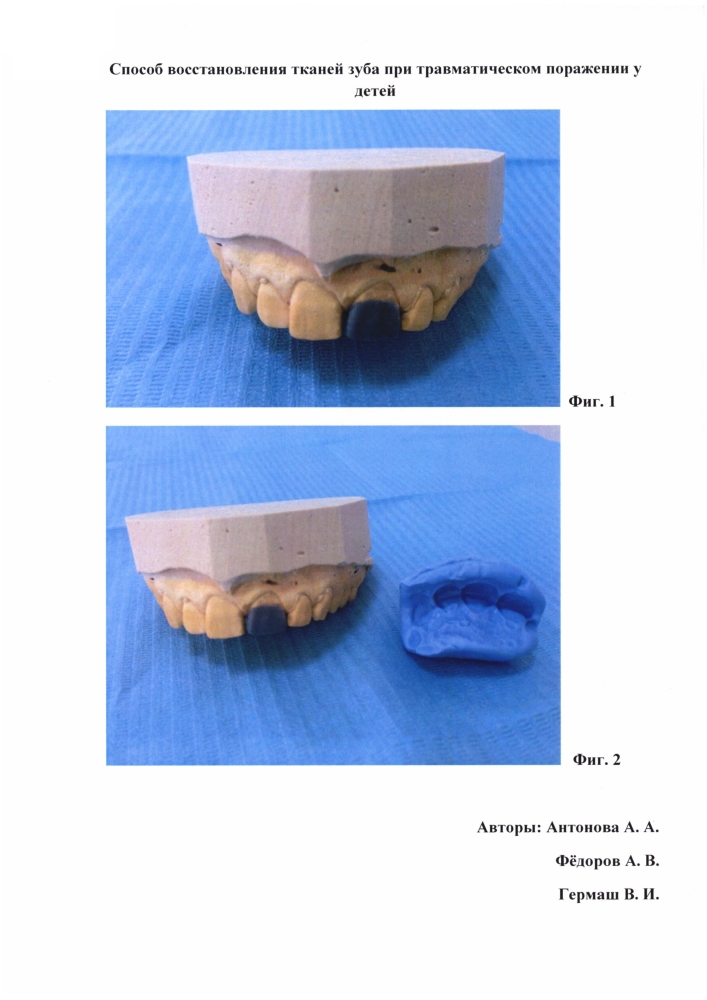 Способ восстановления тканей зуба при травматическом поражении у детей (патент 2604387)