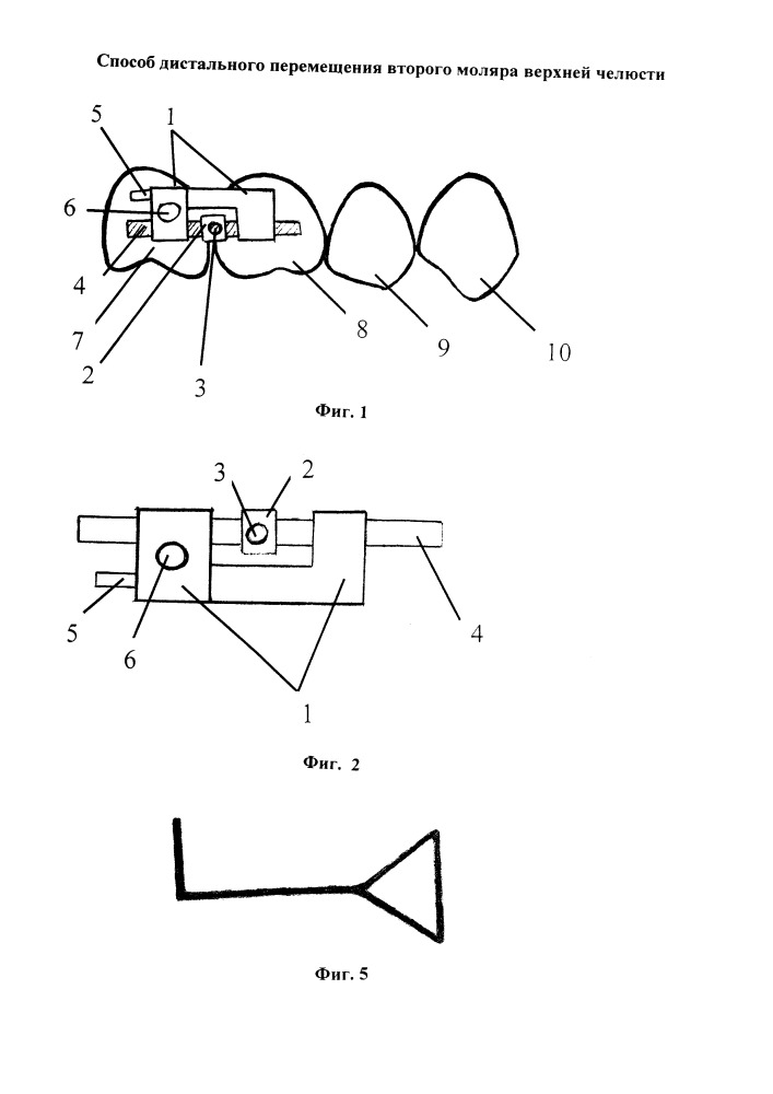 Способ дистального перемещения второго моляра верхней челюсти (патент 2656526)