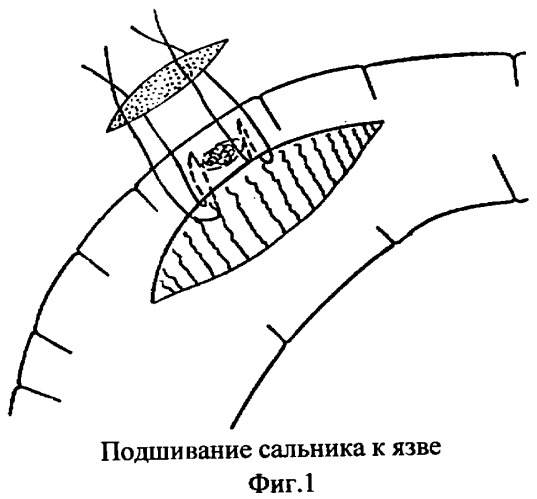 Способ хирургического лечения язвенных кровотечений желудка и двенадцатиперстной кишки (патент 2290882)