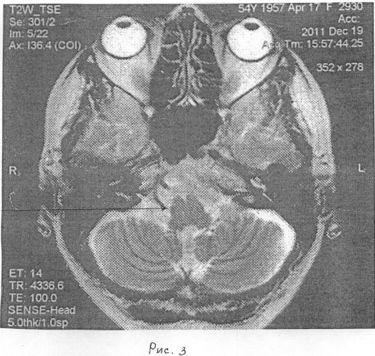 Способ диагностики дисфункции слухопреддверного нерва, вызванной сосудисто-нервным конфликтом (патент 2484769)