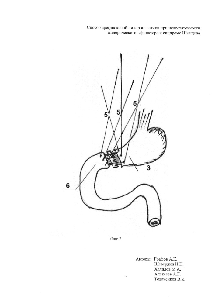 Способ арефлюксной пилоропластики при недостаточности пилорического сфинктера и синдроме шмидена (патент 2663388)