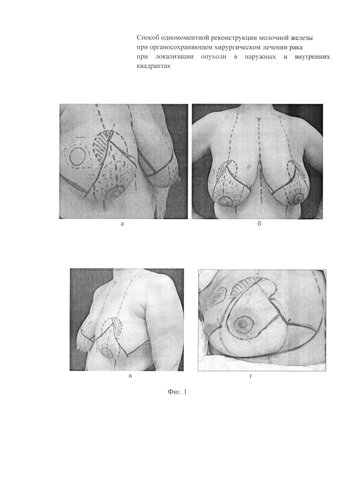 Способ одномоментной реконструкции молочной железы при органосохраняющем хирургическом лечении рака при локализации опухоли в наружных квадрантах (патент 2623453)