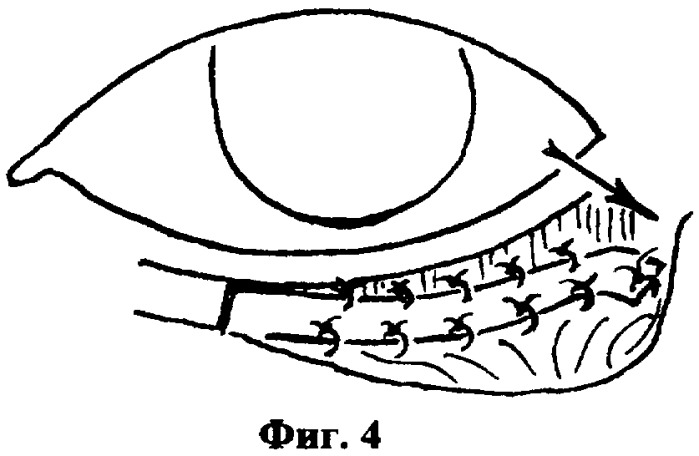 Способ хирургического лечения заворота нижнего века (патент 2342917)