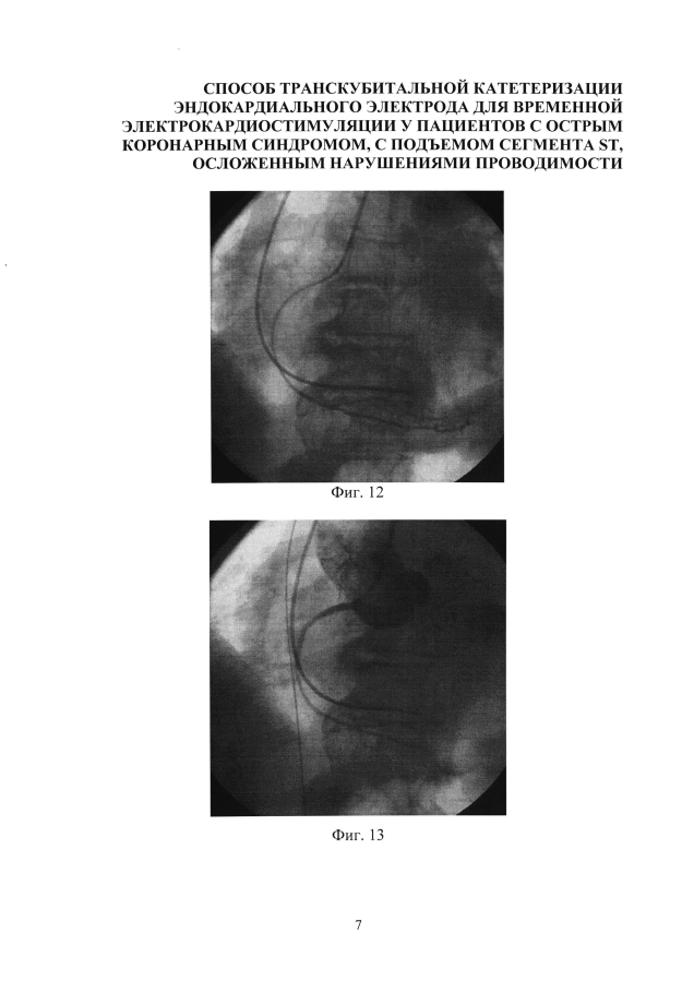 Способ катетеризации сердца для установки эндокардиального электрода для временной электрокардиостимуляции у пациентов с острым коронарным синдромом, с подъемом сегмента st, осложенным нарушениями проводимости (варианты) (патент 2594243)