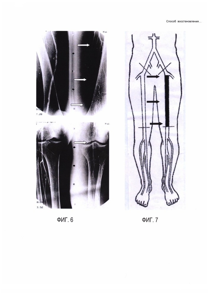 Способ восстановления магистрального артериального кровотока нижних конечностей (патент 2601698)