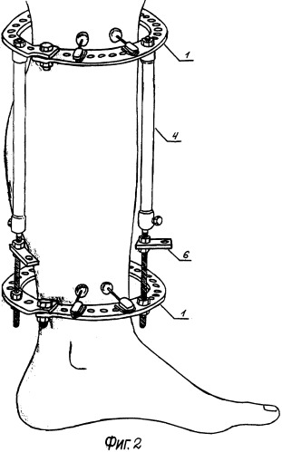 Аппарат для первичного внеочагового остеосинтеза переломов голени (патент 2264188)
