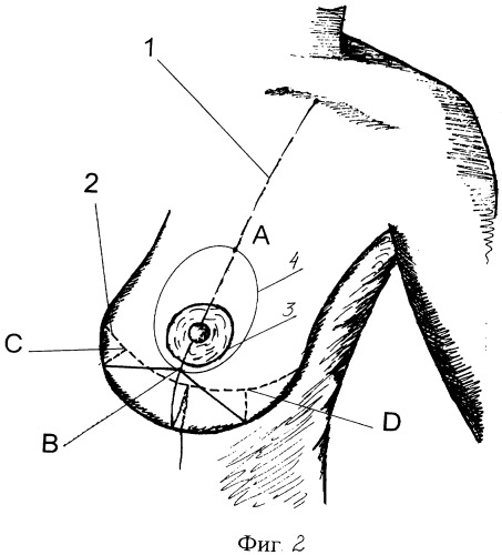 Способ мастопексии (патент 2337628)