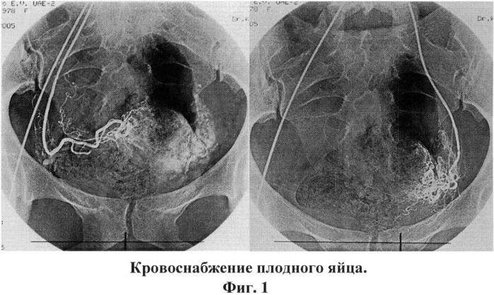 Способ комплексного лечения шеечной беременности (патент 2514548)