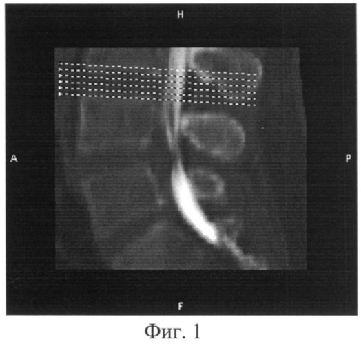 Способ диагностики стенозирующих процессов позвоночного канала и дурального мешка на поясничном уровне (патент 2483675)