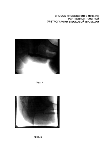 Способ проведения рентгенконтрастной уретрографии в боковой проекции (патент 2592683)