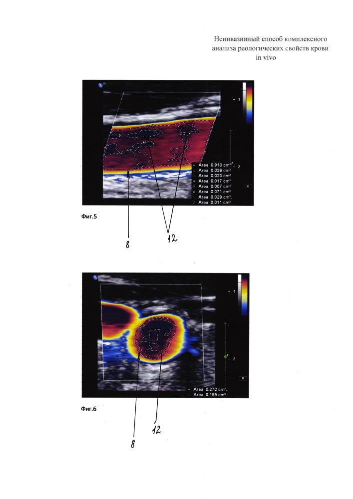 Неинвазивный способ комплексного анализа реологических свойств крови in vivo (патент 2625281)