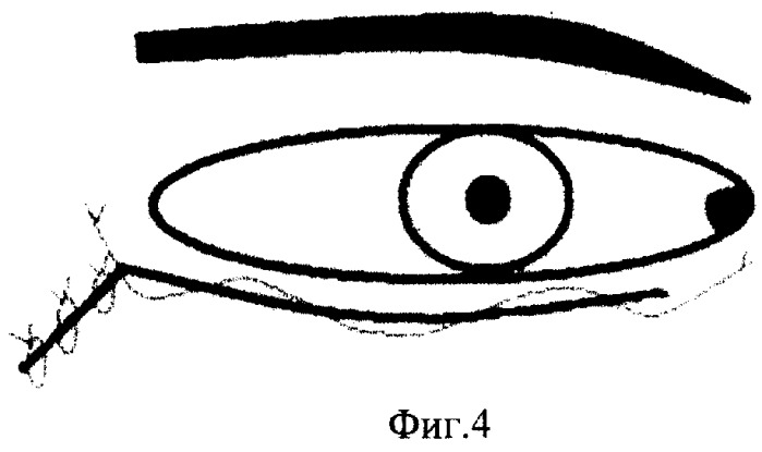 Способ хирургического лечения заворота нижнего века (патент 2254106)