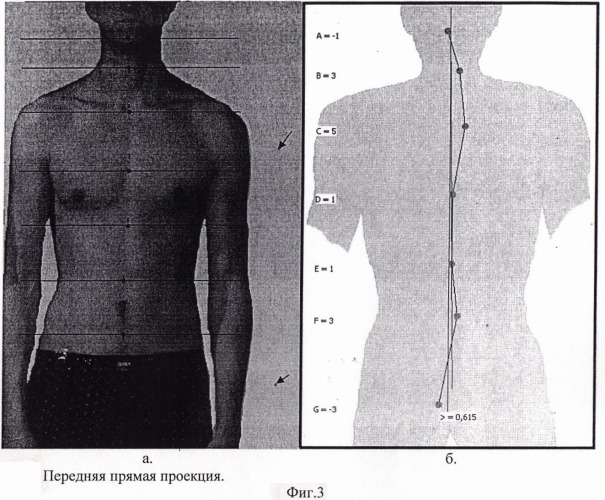 Способ цифровой диагностики деформаций позвоночника (патент 2392855)