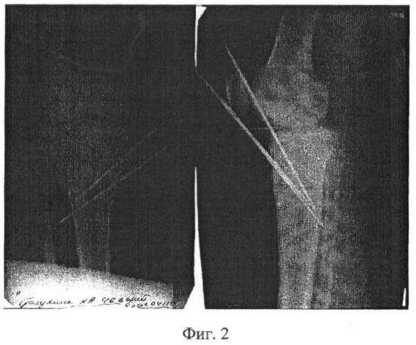 Способ остеосинтеза перелома мыщелка большеберцовой кости (патент 2398538)