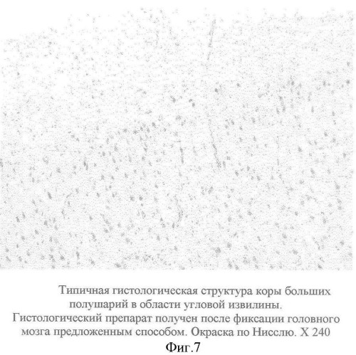 Способ фиксации головного мозга человека без вскрытия полости черепа (патент 2360612)