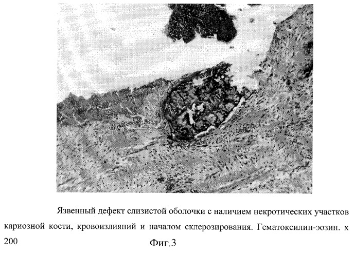 Способ лечения гнойно-воспалительных заболеваний околоносовых пазух (патент 2268048)