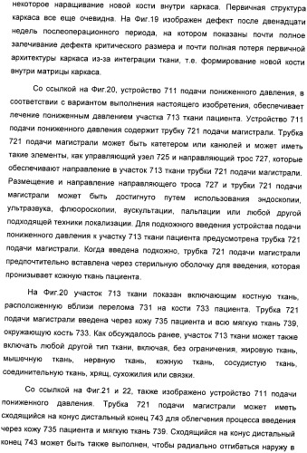 Система и способ продувки устройства пониженного давления во время лечения путем подачи пониженного давления (патент 2404822)