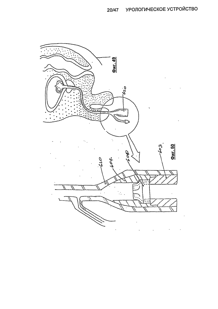 Урологическое устройство (патент 2600865)