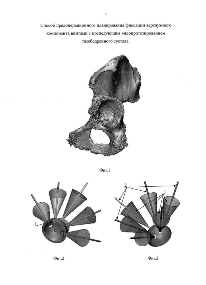 Способ предоперационного планирования фиксации вертлужного компонента винтами с последующим эндопротезированием тазобедренного сустава (патент 2665153)