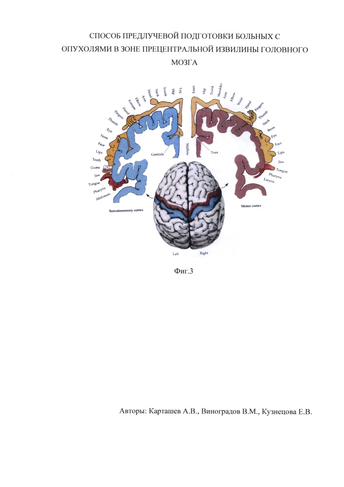 Способ предлучевой подготовки больных с опухолями в зоне прецентральной извилины головного мозга (патент 2632539)