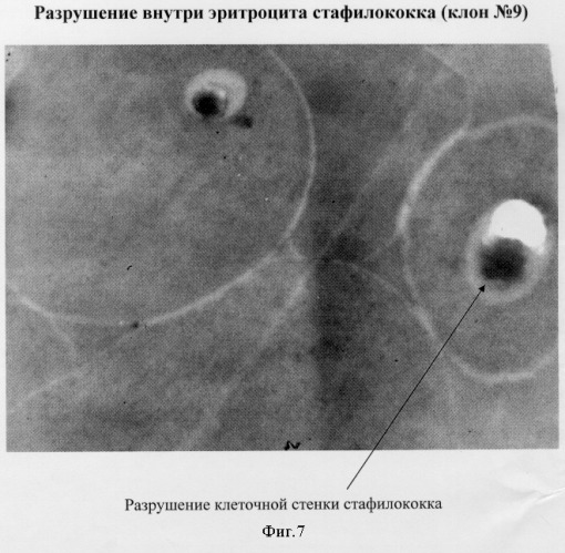 Способ прогнозирования развития анемии при гнойно-воспалительных заболеваниях (патент 2296336)