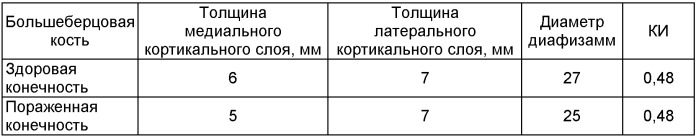 Способ диагностики остеопороза при несращениях костей (патент 2371093)