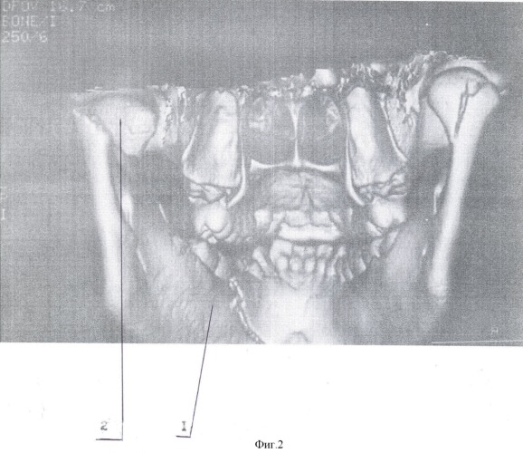 Способ хиругического лечения переломов-вывихов головки суставного отростка нижней челюсти (патент 2355335)
