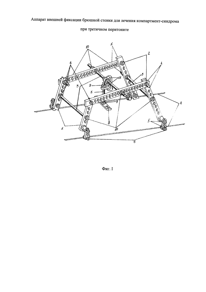 Аппарат внешней фиксации брюшной стенки для лечения компартмент-синдрома при третичном перитоните (патент 2638764)