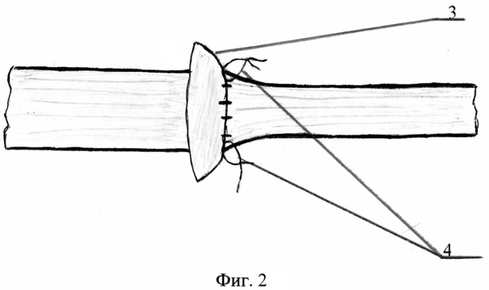 Способ сшивания концов нерва (патент 2572752)