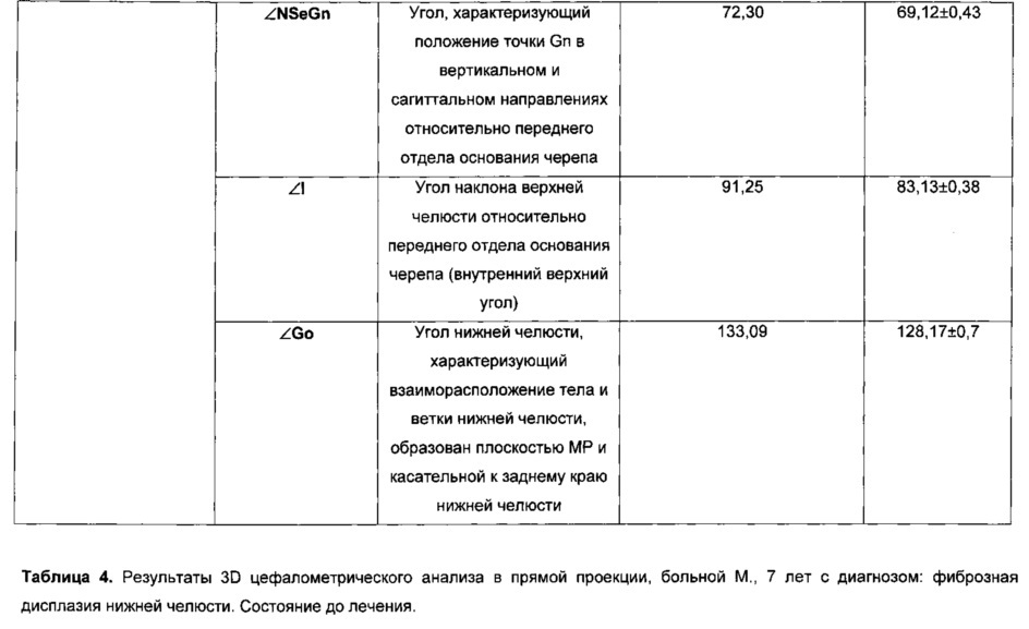 Способ моделирования костно-реконструктивных операций при лечении новообразований челюстных костей в детском возрасте (патент 2607651)