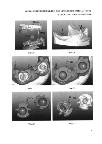 Направляющий шаблон для установки имплантатов и способ его изготовления (патент 2574575)