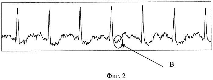 Способ представления электрокардиосигнала (патент 2427314)