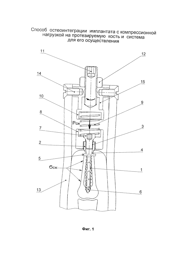 Способ остеоинтеграции имплантата с компрессионной нагрузкой на протезируемую кость и система для его осуществления (патент 2631631)