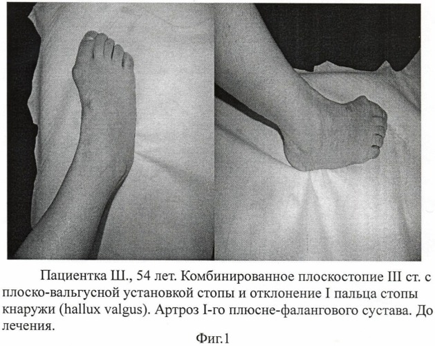 Способ коррекции деформаций стоп (патент 2475215)