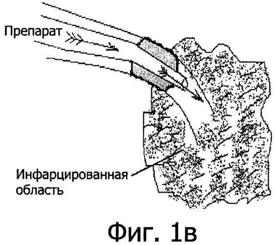 Способ лечения острого инфаркта миокарда (патент 2343921)