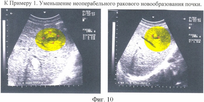 Способ фотоиммунотерапии фотосенсибилизатором, активируемым волновой энергией вне организма человека (патент 2345803)