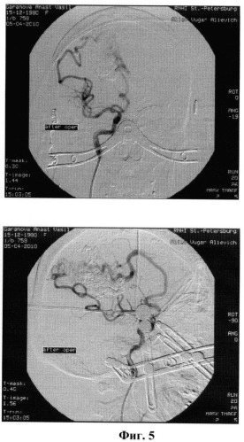 Способ хирургического лечения артериовенозной мальформации головного мозга (патент 2455949)