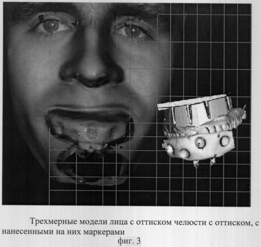 Способ построения трехмерного изображения лица и зубных рядов, сопоставленных в корректном друг относительно друга положении (патент 2306113)