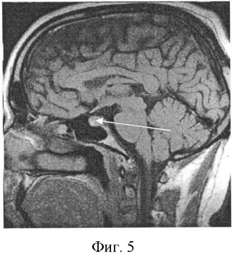 Способ прижизненной диагностики интраселлярной гипертензии на низкопольном магнитно-резонансном томографе (патент 2361512)
