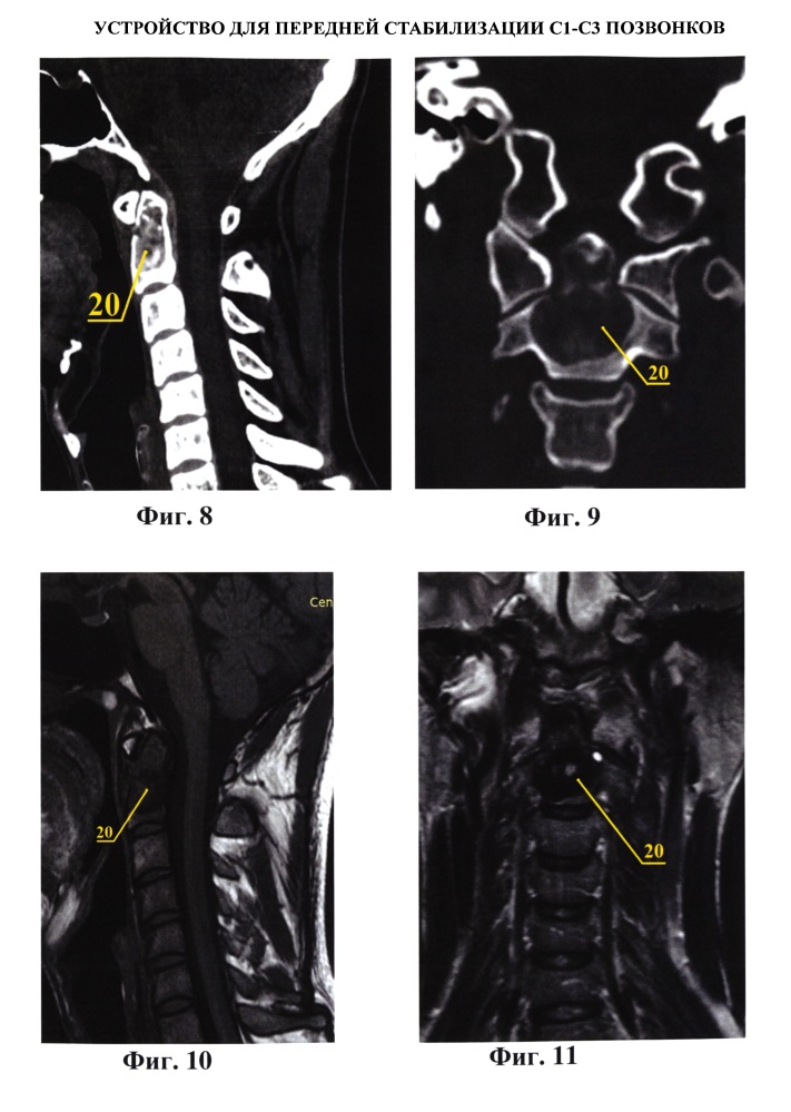 Устройство для передней стабилизации с1-с3 позвонков (патент 2615901)