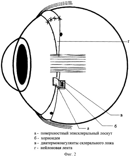 Способ лечения регматогенной отслойки сетчатки (патент 2253421)