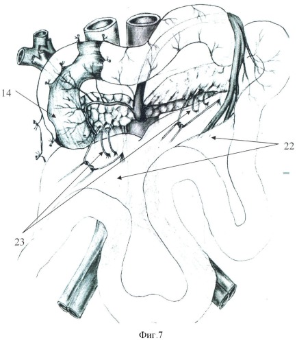 Способ хирургического лечения хронического колостаза, сочетанного с хронической дуоденальной непроходимостью, спланхноптозом и грыжей пищеводного отверстия диафрагмы (патент 2346656)