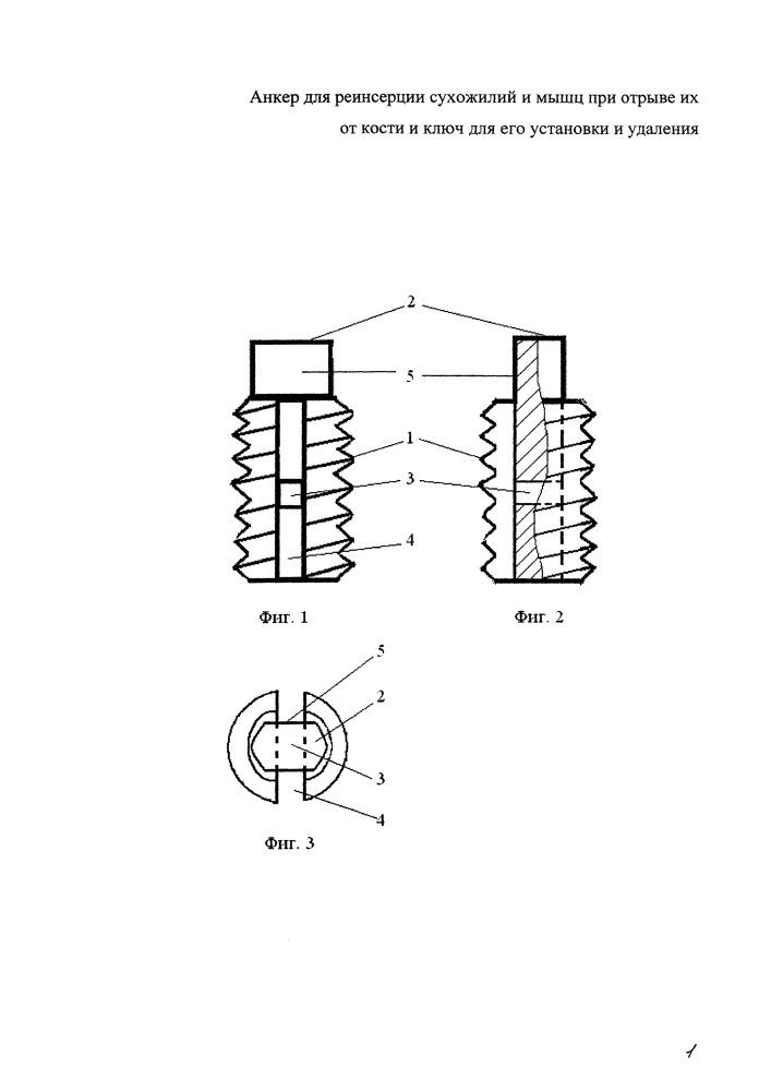 Анкер для реинсерции сухожилий и мышц при отрыве их от кости и ключ для его установки и удаления (патент 2614208)