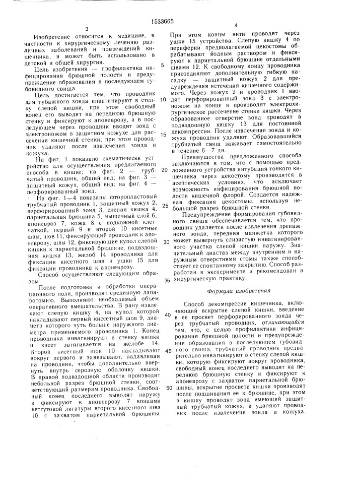 Способ декомпрессии кишечника (патент 1533665)