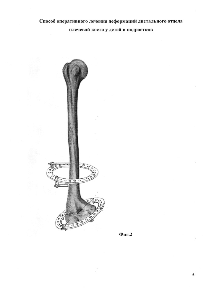 Способ оперативного лечения деформаций дистального отдела плечевой кости у детей и подростков (патент 2628650)
